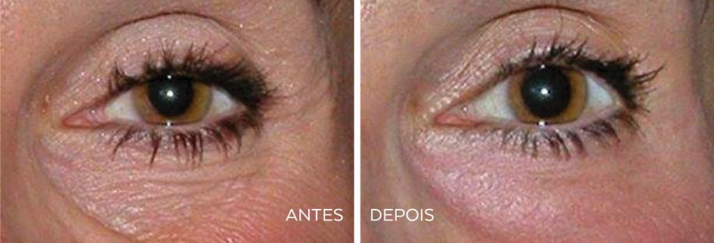 Antes e Depois | Tratamento Estética Facial | SmoothEye